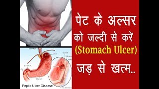 पेट के अल्सर को करें जड़ से ख़त्म Peptic Ulcer Treatment at Home [upl. by Xineohp]