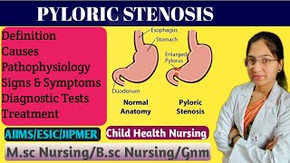 Pyloric Stenosis in Pediatric Nursing  Projectile Vomiting  Causes  Pathophysiology  Treatment [upl. by Greysun]