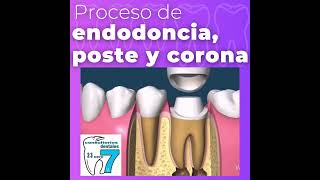 proceso de endodoncia [upl. by Leahplar998]