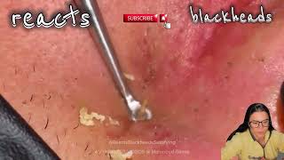 blackhead in ear blackhead in ear removal blackhead in earring hole blackhead in ear extraction [upl. by Lust]