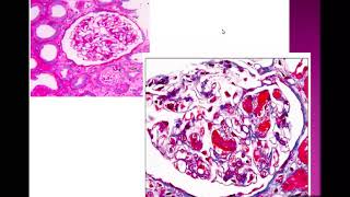 Thrombotic Microangiopathy part 1DrNoha Gamal [upl. by Cornelie]