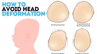 Correct Sleeping Position for Each Stage for Infants to Avoid Head Deformation  flat head syndrome [upl. by Nnasor]