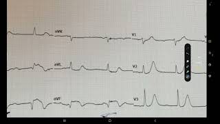 ECG week 15 Syncopal attack [upl. by Lovato]