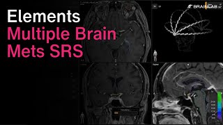 Radiosurgery Solution for Treatment of Multiple Brain Metastases  Multiple Brain Mets SRS [upl. by Felipe]