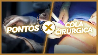 Pontos sutura versus cola cirúrgica Qual técnica é mais eficaz [upl. by Bobbe261]