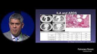 PreClinical ILD  Gary M Hunninghake MD [upl. by Gnek554]