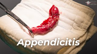 What Causes Appendicitis amp How to Treat It [upl. by Osbourne]