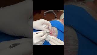 Surprise Scalp Cyst [upl. by Nicolina531]