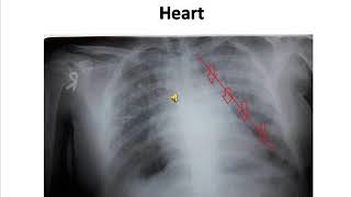 Mitralization of Heart  Chest Xray of Mitral Stenois [upl. by Gnof]