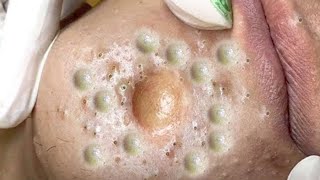 Big Cystic Acne Blackheads Extraction Blackheads amp Milia Whiteheads Removal Pimple Popping  3610 [upl. by Nodmac]