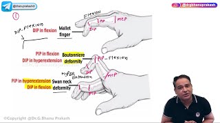 Rheumatoid arthritis Hindi  Causes Symptoms Diagnosis and Treatment  Orthopedic Lectures [upl. by Cherri]