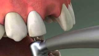 Dentist  Maryland Bridge Procedure [upl. by Fugere]