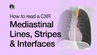 How to Read a Chest XRay Mediastinal Lines Stripes amp Interfaces [upl. by Haikan]