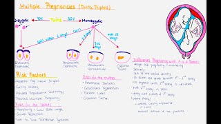 Multiple Pregnancy Twins Triplets  Zygosity Chorionisity Amnionisity Risks Delivery [upl. by Brana]