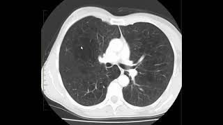 Enfisema pulmonar centrilobular [upl. by Esoryram]