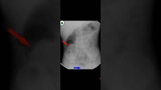 3 year old baby pneumatic enema for intussusception Awerenes of all [upl. by Olin]