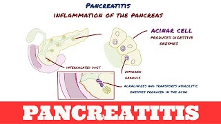 Pancreatitis [upl. by Azilanna]