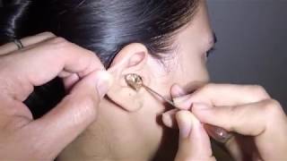 Womans Earwax Finally Removed after 25 Years [upl. by Cicily]