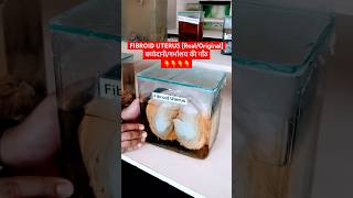 Fibroid uterus  बच्चेदानी की गाँठ । Uterine myoma [upl. by Selene994]