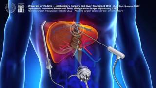 Modified ALPPS totally laparoscopic LAPS  ALPPS modificata LAPS totalmente laparoscopica [upl. by Kendall234]