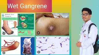 Wet Gangrene Pathology Why Moist Tissues Affected [upl. by Navis]