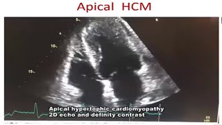 Cardiomyopathy Echo by Prof Dr Tuhin Haque madam [upl. by Nicolis]