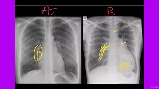 CONGENITAL HEART DISEASES amp EISENMENGER SYNDROME HOW TO APPROACH ON CHEST RADIOGRAPh BY DR NAEEM🚦 [upl. by Sacksen872]