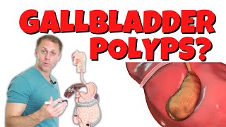 Why Do I Have Gallbladder Polyps [upl. by Laekcim]