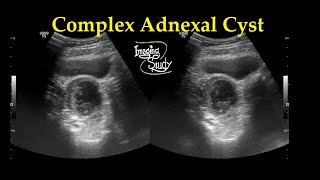 Complex Adnexal Cyst  Ultrasound  Case 27 [upl. by Dorej101]