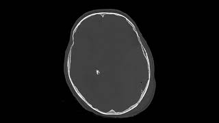 Extradural hemorrhage2 [upl. by Herring]