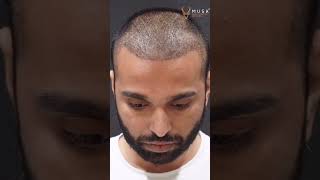 Hair Transplant Journey Day By Day  Artas Robotic Hair Transplant  Musk Clinic [upl. by Animas]