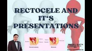 RECTOCELE VARIOUS SURGICAL OPTIONS FOR THIS TROUBLESOME DISEASE [upl. by Paugh]