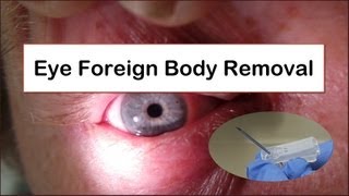 Eye Foreign Body Removal [upl. by Anemaj]