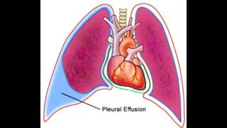 Pleural Effusions  Transudate Exudate amp Lymphatic [upl. by Jennilee]