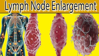 Lymph Node Enlargement  7 Most common causes [upl. by Race]