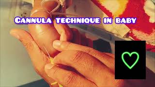 How to Cannulate an Infant Pediatric Cannulation Techniques [upl. by Sukcirdor402]