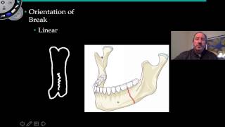 Types of Fractures [upl. by Hein656]