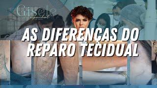 As Diferenças do Reparo Tecidual  Remover 50 [upl. by Fanchan]