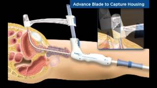 TSPeC® Illustrated Procedure  German [upl. by Milzie]