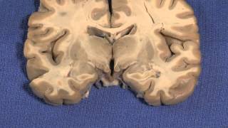 Hypothalamus Neuroanatomy Video Lab  Brain Dissections [upl. by Siaht]