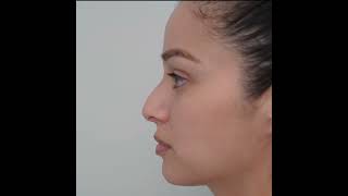 Rhinoplasty by Dr Vladimir Grigoryants  Los Angeles California [upl. by Netloc]