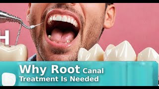 Dental Abcess Why Root Canal Treatment Is Needed [upl. by Alyekahs]