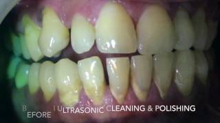 Before amp After Ultrasonic Cleaning amp Polishing Of Teeth amp Gums [upl. by Gwenore43]