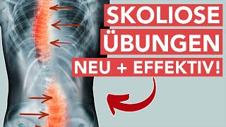 Skoliose übungen  Neue effektive Behandlungsmethode [upl. by Jodee]