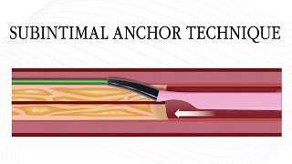 Subintimal Anchor Technique DualLumen Catheter Tutorial [upl. by Yrreg]