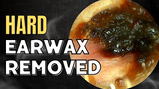 SOLID Hard Earwax Removed After Weeks [upl. by Hunger412]