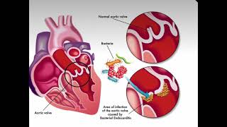 انتقال البكتيريا من السن الى القلب Infective endocarditis [upl. by Ahsitaf]