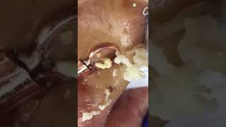 Remove ACNE FAST With These Treatment Secrets110 dermatologia acne blackheads pimple [upl. by Kela]