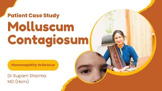 Successful Case Study of Molluscum Contagiosum Dr Rupam Sharma Homoeopathy [upl. by Georg]