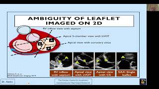 تقييم صمامات الجهة اليمنى من القلب بالإيكو Echocardiographic Evaluations of The Right Sided Valves [upl. by Humpage]